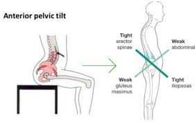 Anterior Pelvic Tilt Causes And It's Effects