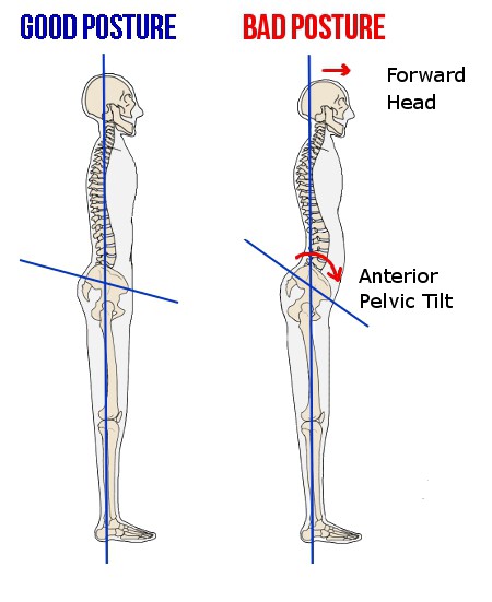 What Is Anterior Pelvic Tilt